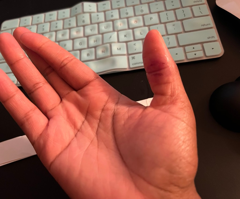 A photo of keyboard and a hand that has two cut on the thumb.